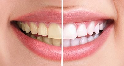 teeth-whitening-york