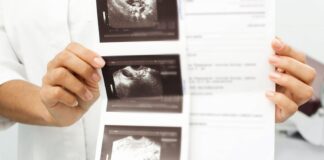 Could Dry Jan help with your polycystic ovary syndrome (PCOS)?