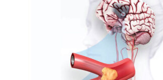 May is National Stroke Awareness Month. Here are the most common causes and risk factors.