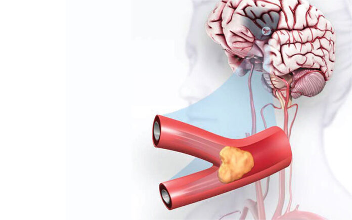 illustration_of_a_stroke