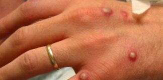 Travel Insurer Confirms Cover For ‘Monkeypox’ Virus