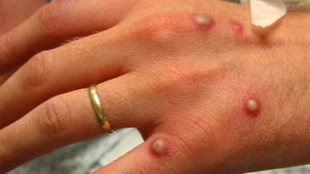 monkeypox-white-skin