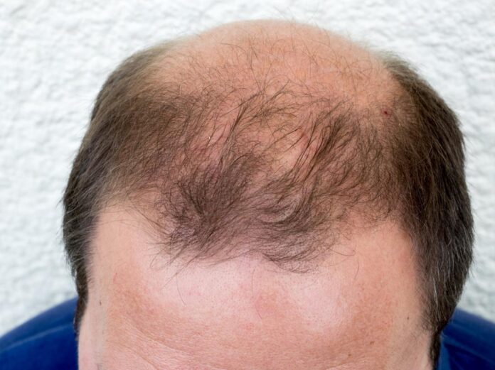 male-pattern-baldness