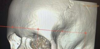 3D printed jaw, a life changer for Saudi cancer patient