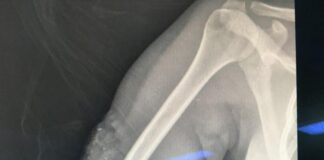 Pregnant woman and fetus miraculously survive hit and run